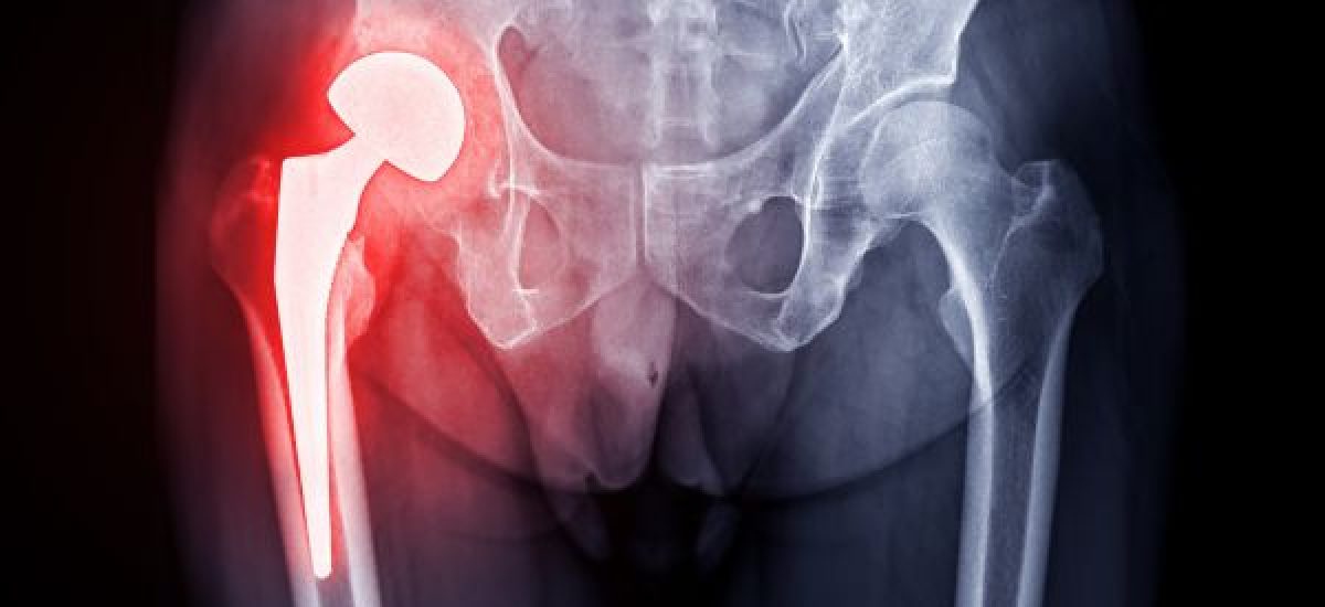 Hip replacement